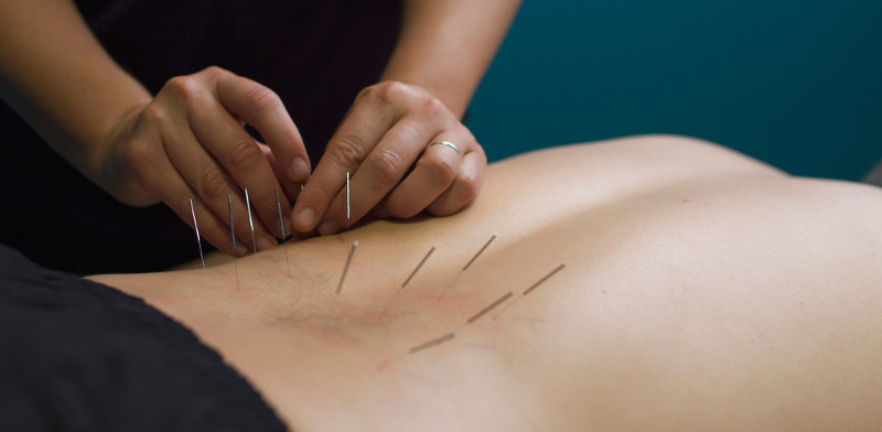 dry needling supplies